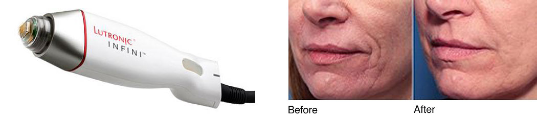 INFINIskin High Intensity Focused RF Microneedling
