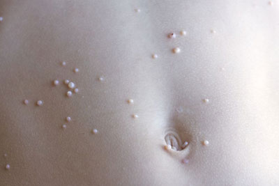 Molluscum Contagiosum Dermatology